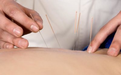 5 Reasons to Try Dry Needling For Pain Relief
