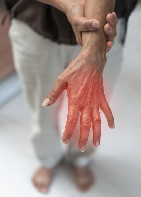 Peripheral Neuropathy